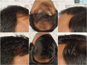 best-hair-transplant-in-turkey (27)