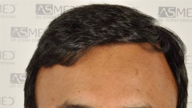 best-hair-transplant-in-turkey (3)