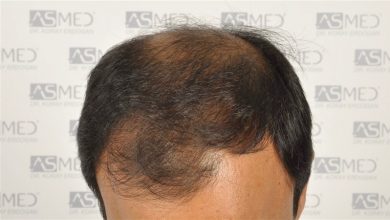 best-hair-transplant-in-turkey (5)