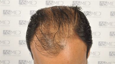 best-hair-transplant-in-turkey (6)