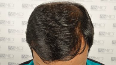 best-hair-transplant-in-turkey (8)