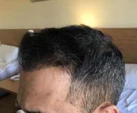 hair-transplant-in-antalya (1)