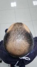hair-transplant-in-antalya (10)