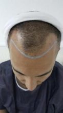 hair-transplant-in-antalya (11)