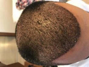 hair-transplant-in-antalya (12)