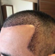 hair-transplant-in-antalya (13)