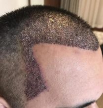 hair-transplant-in-antalya (14)
