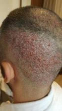 hair-transplant-in-antalya (16)