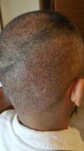 hair-transplant-in-antalya (17)