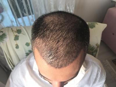hair-transplant-in-antalya (19)