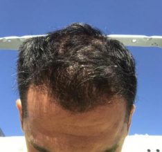 hair-transplant-in-antalya (2)