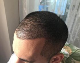 hair-transplant-in-antalya (20)