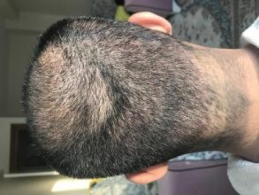 hair-transplant-in-antalya (22)