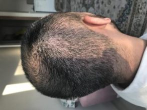 hair-transplant-in-antalya (23)