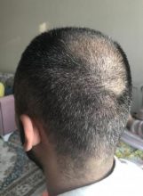 hair-transplant-in-antalya (24)