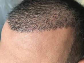 hair-transplant-in-antalya (25)