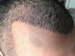 hair-transplant-in-antalya (26)