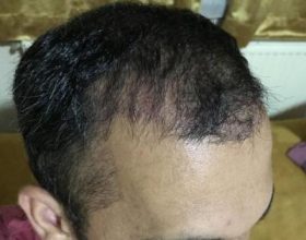 hair-transplant-in-antalya (27)