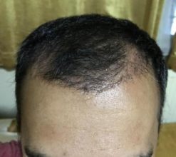 hair-transplant-in-antalya (28)