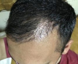 hair-transplant-in-antalya (29)