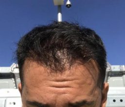 hair-transplant-in-antalya (3)