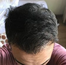 hair-transplant-in-antalya (31)