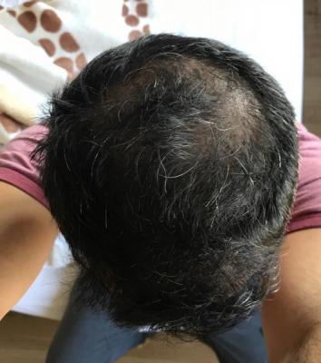 hair-transplant-in-antalya (32)