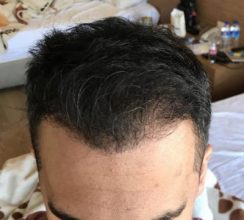 hair-transplant-in-antalya (33)