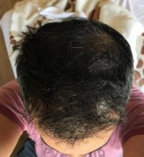 hair-transplant-in-antalya (34)