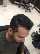 hair-transplant-in-antalya (4)