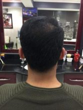 hair-transplant-in-antalya (5)