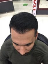 hair-transplant-in-antalya (6)