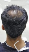 hair-transplant-in-antalya (8)