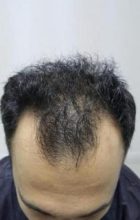 hair-transplant-in-antalya (9)