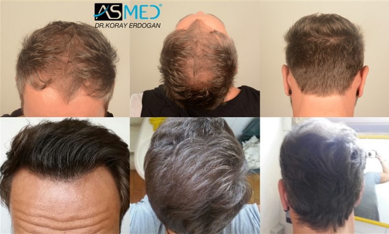 hair-transplant-in-turkey-before-and-after (10)