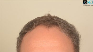 hair-transplant-in-turkey-before-and-after (11)