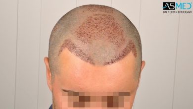 hair-transplant-turkey-asmed