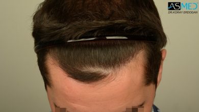 hair-transplant-turkey-asmed