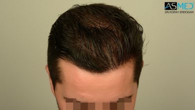 hair-transplant-turkey-asmed