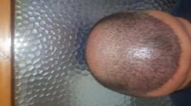beard-hair-transplant (10)