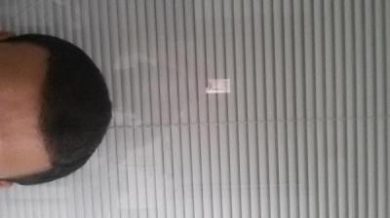 beard-hair-transplant (12)