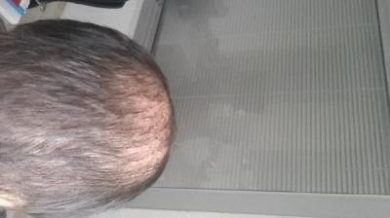 beard-hair-transplant (13)