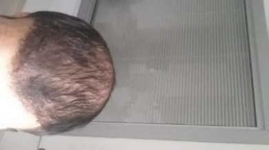 beard-hair-transplant (14)