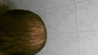 beard-hair-transplant (16)