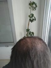 beard-hair-transplant (17)