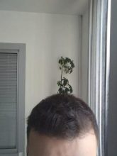 beard-hair-transplant (18)