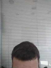 beard-hair-transplant (19)