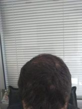 beard-hair-transplant (20)