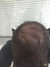 beard-hair-transplant (21)