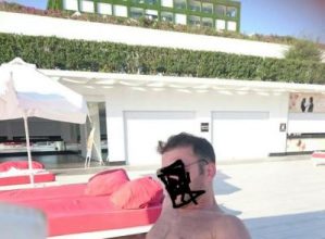 beard-hair-transplant (23)